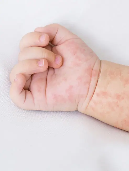 Dermatologie Pediatrica - doctor Natalia Dumitrescu