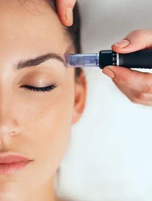 Estetica​ - Microneedling - Doctor Natalia Dumitrescu