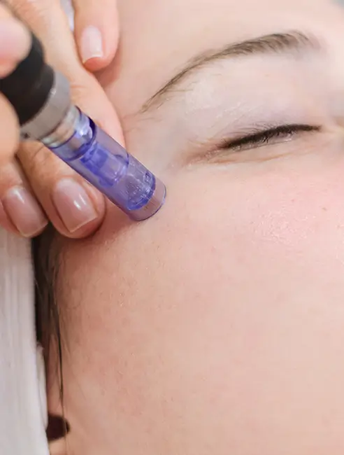 Estetica​ - Microneedling - Doctor Natalia Dumitrescu